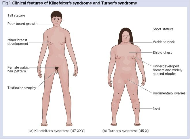 Fig-1-Clinical-features-of-Klinefelters-syndrome-and-Turners-syndrome_660.jpg